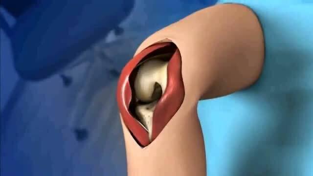 国产膝关节样品视频